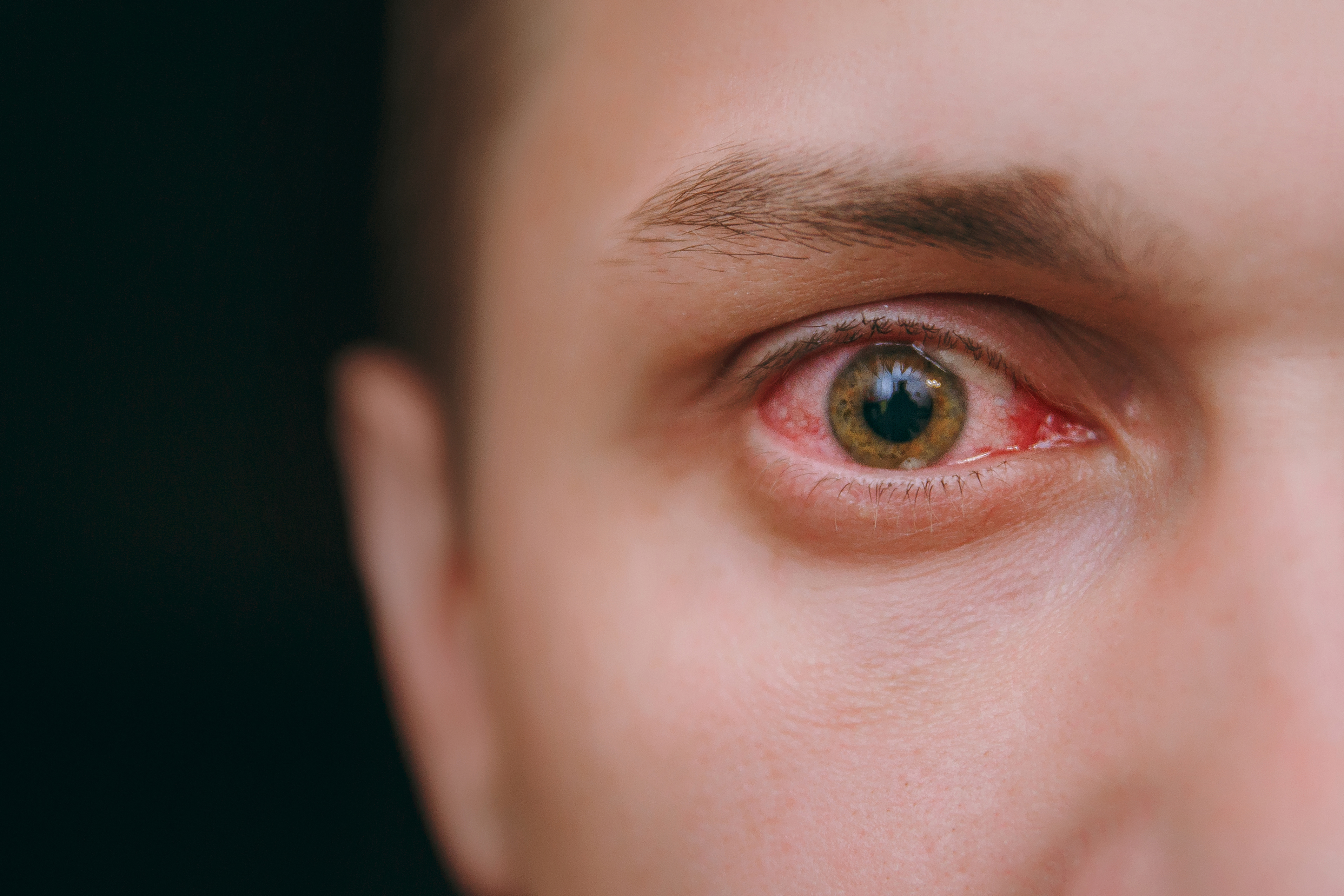 Os olhos são responsáveis por traduzir para o cérebro cerca de 80% das informações que recebemos. Saiba mais sobre as alergias e infecções nos olhos.